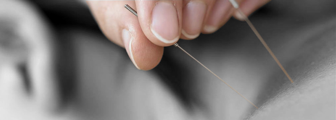 Acupuncture